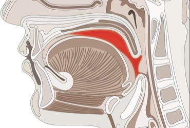 Airway Management in Patients With Oropharyngeal Masses