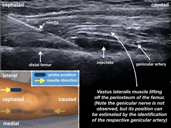 To the Recipe for TKA Analgesia, Add the Genicular Nerve Block