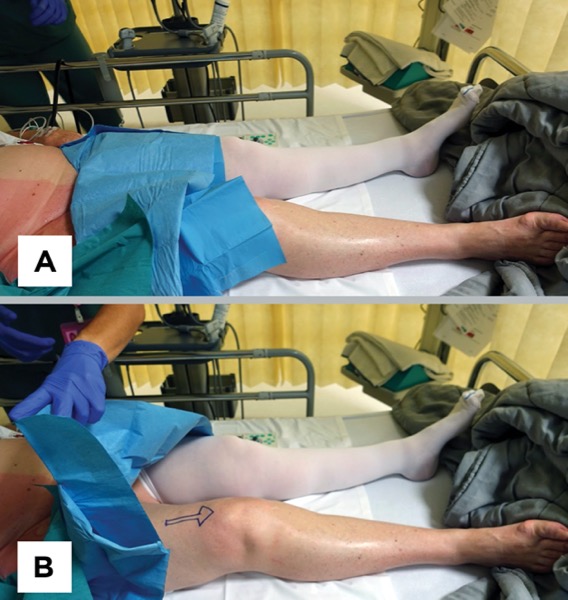 Prevention of Wrong-Side Nerve Blocks: Part 2