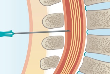 Accidental Dural Puncture During Labor Epidural