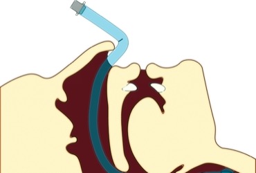 Managing Epistaxis Caused by Nasal Intubation During Dental Surgery