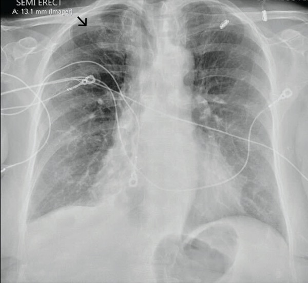 Porous Diaphragm Syndrome: Spontaneous Pneumothorax After Diagnostic ...