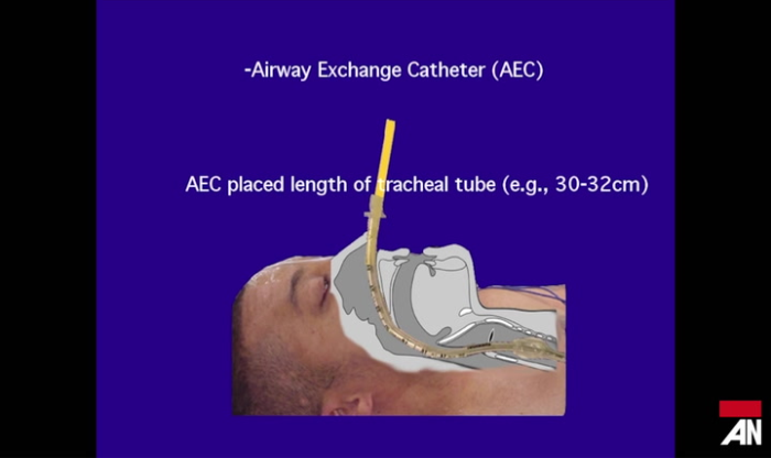 Airway on Demand: Airway Exchange Catheter Tutorial